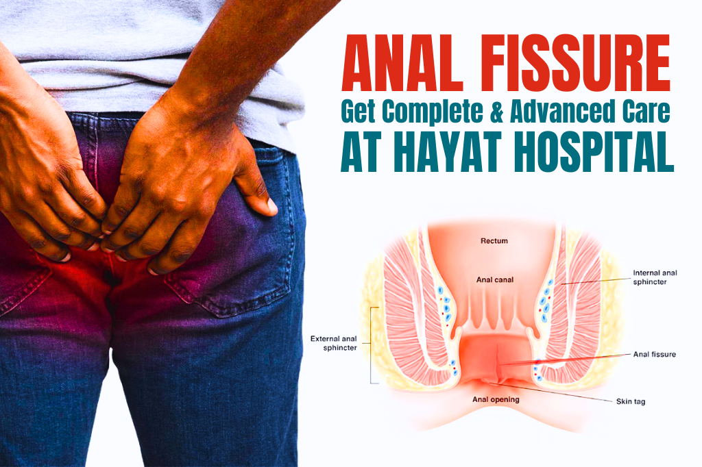 Anal Fissure – Causes, Symptoms and Advanced Treatment