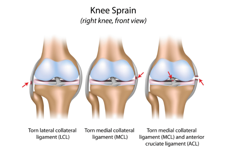 Understanding Knee Ligament Injuries