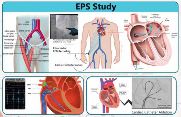EP Study and RFA Treatment in Guwahati
